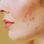 Benzene-Found-in-Acne-Treatments-How-to-Stay-Safe-Bewellmag.com_-1024x656