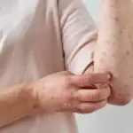 Measles-Bewellmag.com_-1024x656