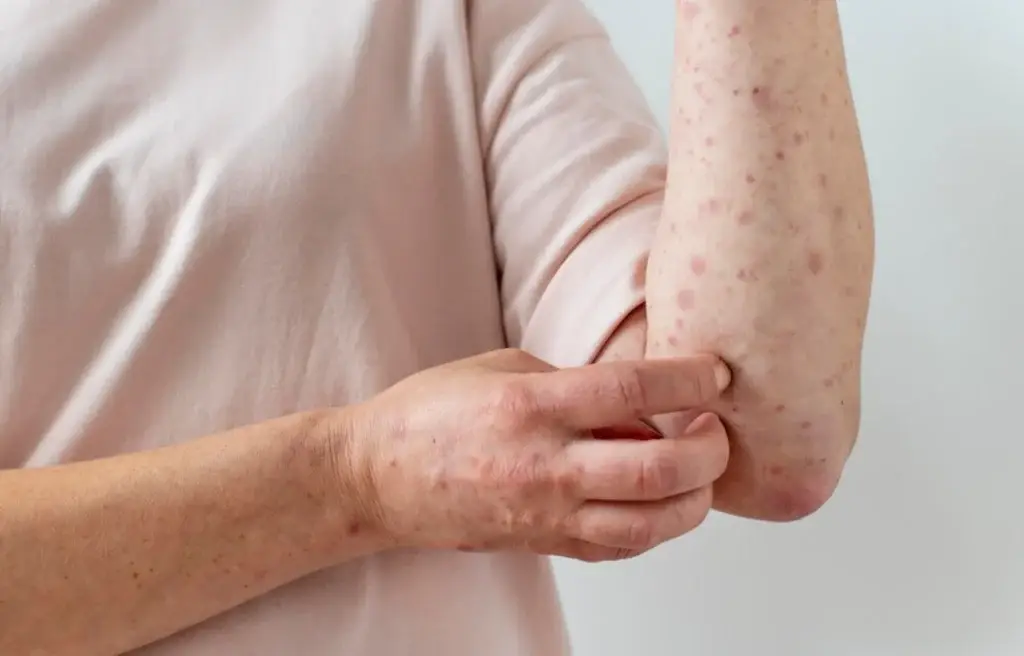 Measles-Bewellmag.com_-1024x656